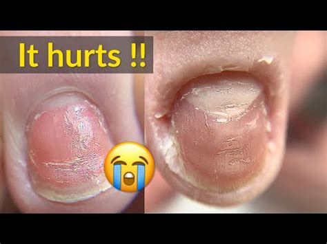 cream para sa patay na kuko|Patay Na Kuko: Anong .